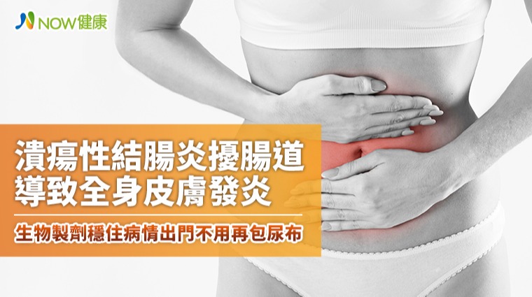 潰瘍性結腸炎擾腸道導致全身皮膚發炎 生物製劑穩住病情出門不用再包尿布 潰瘍性結腸炎擾腸道導致全身皮膚發炎 生物製劑穩住病情出門不用再包尿布