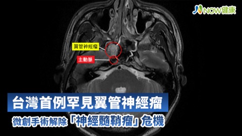 台灣首例罕見翼管神經瘤 微創手術解除「神經髓鞘瘤」危機