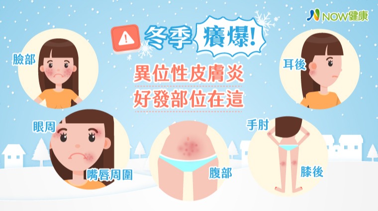 冬季癢爆 異位性皮膚炎好發部位在這 冬季癢爆 異位性皮膚炎好發部位在這