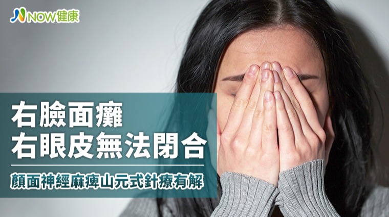 右臉面癱右眼皮無法閉合 顏面神經麻痺山元式針療有解 右臉面癱右眼皮無法閉合 顏面神經麻痺山元式針療有解