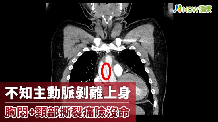 不知主動脈剝離上身 胸悶+頸部撕裂痛險丟命 不知主動脈剝離上身 胸悶+頸部撕裂痛險丟命