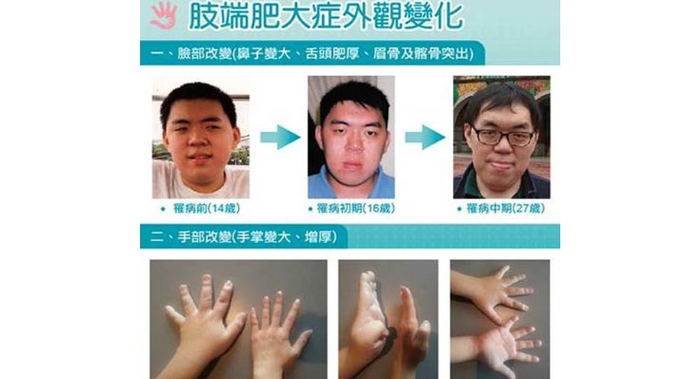 肢端肥大症外觀變化 肢端肥大症外觀變化