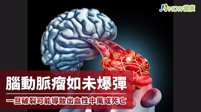腦動脈瘤如未爆彈 一旦破裂可能導致出血性中風或死亡 腦動脈瘤如未爆彈 一旦破裂可能導致出血性中風或死亡