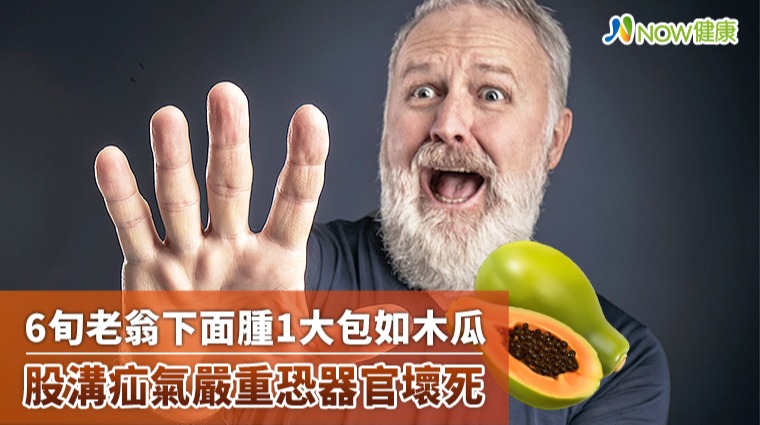6旬老翁下面腫1大包如木瓜 股溝疝氣嚴重恐器官壞死 6旬老翁下面腫1大包如木瓜 股溝疝氣嚴重恐器官壞死