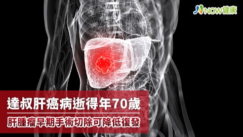 達叔肝癌病逝得年70歲 肝腫瘤早期手術切除可降低復發