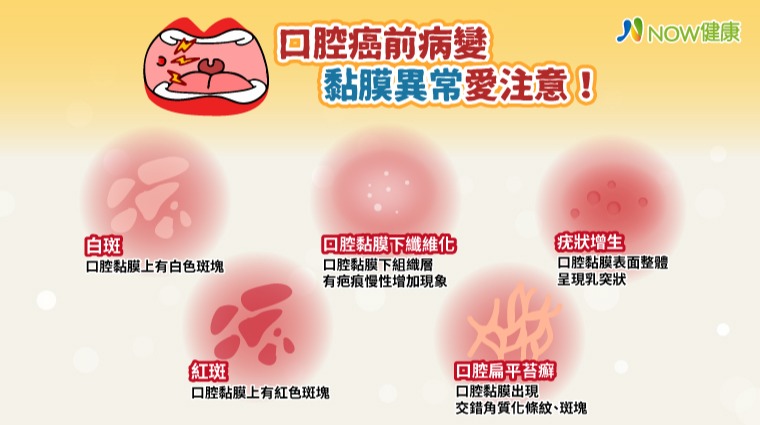 口腔癌前病變 黏膜異常愛注意! 口腔癌前病變 黏膜異常愛注意!
