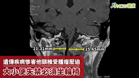 遺傳疾病慘害他頸椎受腫瘤壓迫 大小便失禁必須坐輪椅