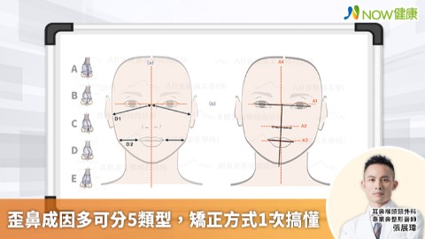 歪鼻成因多可分5類型 矯正方式1次搞懂