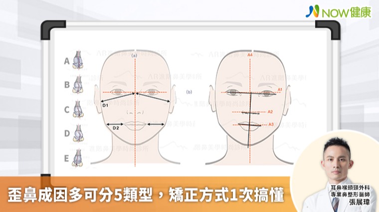 歪鼻成因多可分5類型 矯正方式1次搞懂