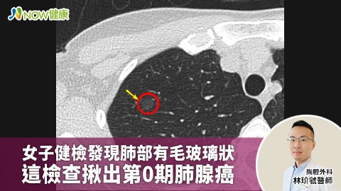 女子健檢發現肺部有毛玻璃狀 這檢查揪出第0期肺腺癌