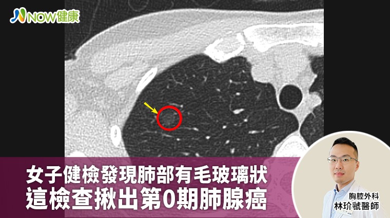 女子健檢發現肺部有毛玻璃狀 這檢查揪出第0期肺腺癌 女子健檢發現肺部有毛玻璃狀 這檢查揪出第0期肺腺癌