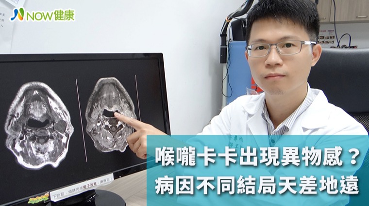 喉嚨卡卡出現異物感? 病因不同結局天差地遠 喉嚨卡卡出現異物感? 病因不同結局天差地遠