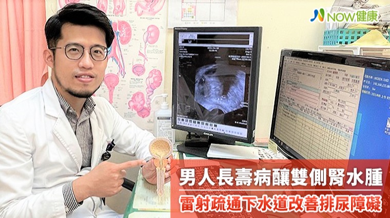 男人長壽病釀雙側腎水腫 雷射疏通下水道改善排尿障礙 男人長壽病釀雙側腎水腫 雷射疏通下水道改善排尿障礙
