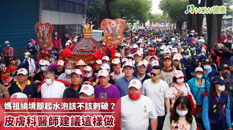 媽祖繞境腳起水泡該不該刺破？ 皮膚科醫師建議這樣做