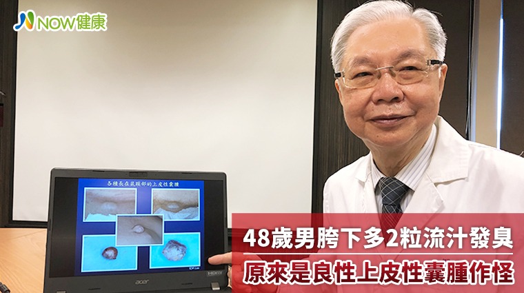 48歲男胯下多2粒流汁發臭 原來是良性上皮性囊腫作怪 48歲男胯下多2粒流汁發臭 原來是良性上皮性囊腫作怪