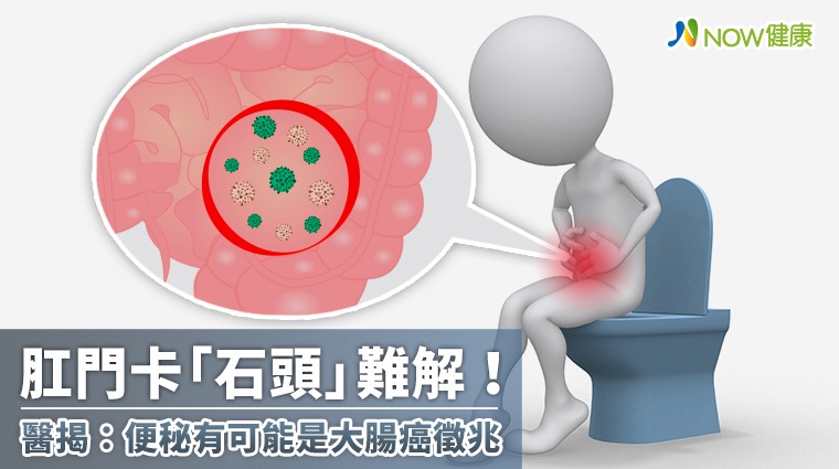 肛門卡「石頭」難解! 醫揭:便秘有可能是大腸癌徵兆 肛門卡「石頭」難解! 醫揭:便秘有可能是大腸癌徵兆