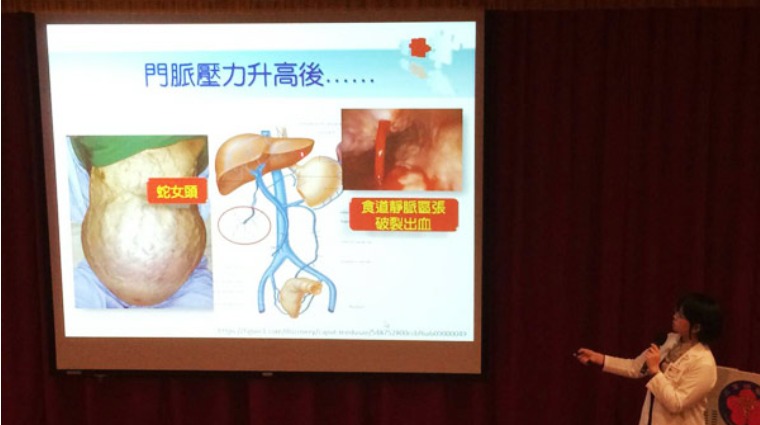 肝硬化患者肝門靜脈異常 肝硬化患者肝門靜脈異常
