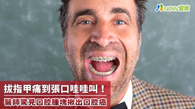 拔指甲痛到張口哇哇叫! 醫師驚見口腔腫塊揪出口腔癌 拔指甲痛到張口哇哇叫! 醫師驚見口腔腫塊揪出口腔癌