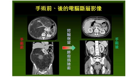 李小姐手術前後影像