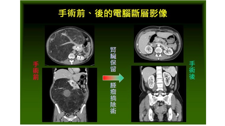 李小姐手術前後影像 李小姐手術前後影像