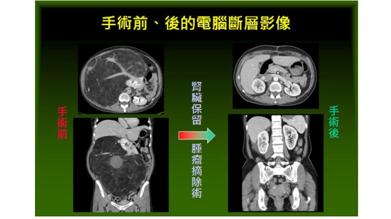 李小姐手術前後影像