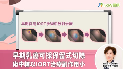 早期乳癌可採保留式切除 術中輔以IORT治療副作用小