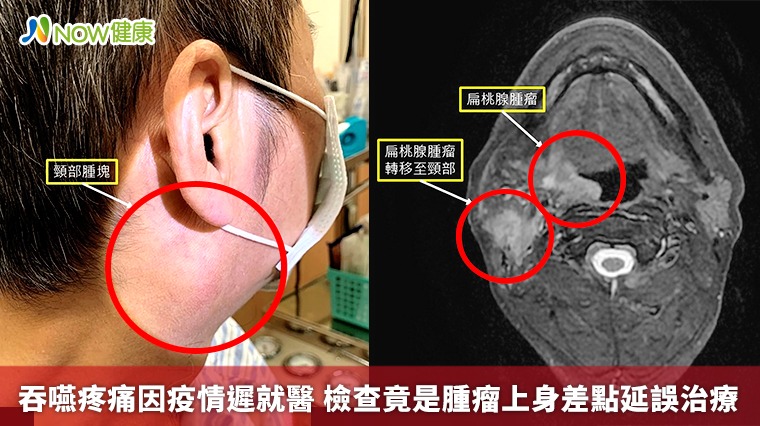 吞嚥疼痛因疫情遲就醫 檢查竟是腫瘤上身差點延誤治療