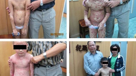 乾癬是一種自體免疫系統失調所引起的疾病，不是皮膚病、也不會傳染