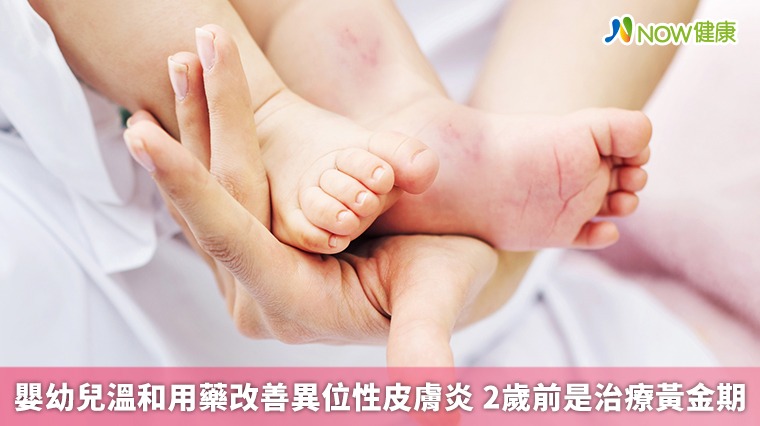 嬰幼兒溫和用藥改善異位性皮膚炎 2歲前是治療黃金期 嬰幼兒溫和用藥改善異位性皮膚炎 2歲前是治療黃金期