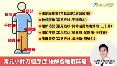 常見小針刀適應症 緩解各種痠麻痛