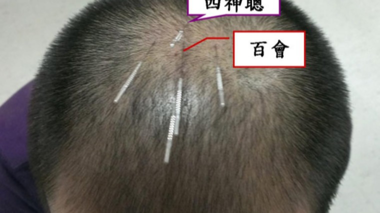 雄性禿 雄性禿