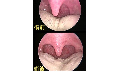 聲線美容手術 美聲男歌手高音飆更高