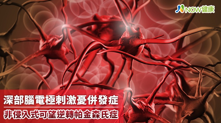 深部腦電極刺激憂併發症 非侵入式治療減少75%用藥 深部腦電極刺激憂併發症 非侵入式治療減少75%用藥