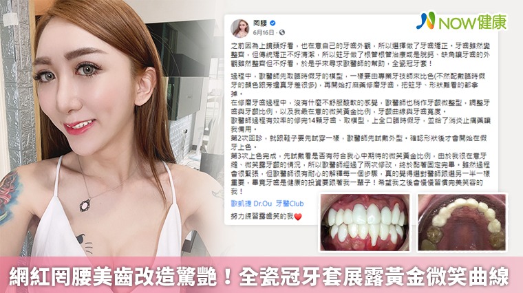 網紅罔腰美齒改造驚艷! 全瓷冠牙套展露黃金微笑曲線 網紅罔腰美齒改造驚艷! 全瓷冠牙套展露黃金微笑曲線