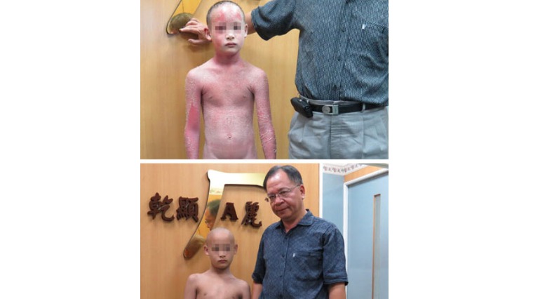 乾癬性紅皮症好發成人 不當治療病情難以收拾