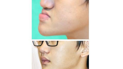 外胚層增生不良症 口腔顎顏面重建變美男