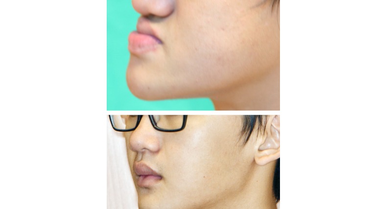 外胚層增生不良症 口腔顎顏面重建變美男
