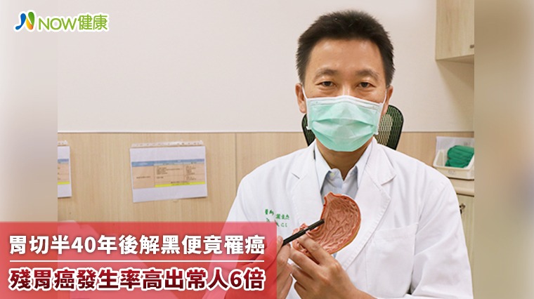 胃切半40年後解黑便竟罹癌 殘胃癌發生率高出常人6倍 胃切半40年後解黑便竟罹癌 殘胃癌發生率高出常人6倍