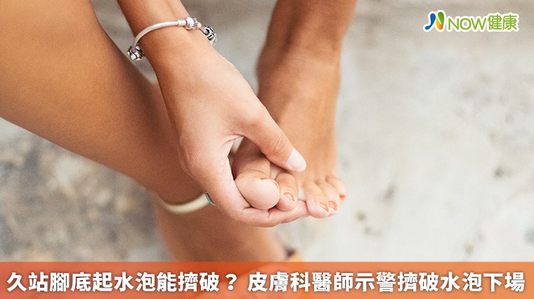 久站腳底起水泡能擠破? 皮膚科醫師示警擠破水泡下場 久站腳底起水泡能擠破? 皮膚科醫師示警擠破水泡下場