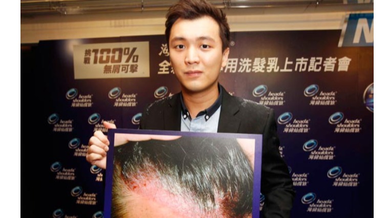 錯用洗髮精 男大生險禿頭 錯用洗髮精 男大生險禿頭