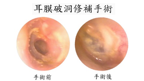 微創耳膜修補手術 治療中耳炎合併耳膜破損