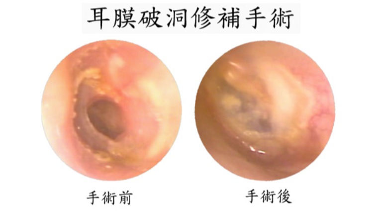 微創耳膜修補手術 治療中耳炎合併耳膜破損