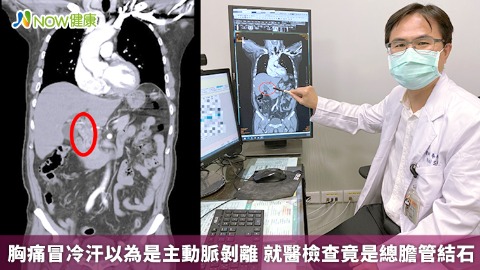 胸痛冒冷汗以為是心臟剝離 就醫檢查竟是總膽管結石