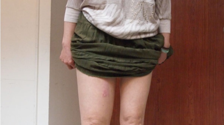 顯微血管手術 挽救婦癌患者象腿 顯微血管手術 挽救婦癌患者象腿