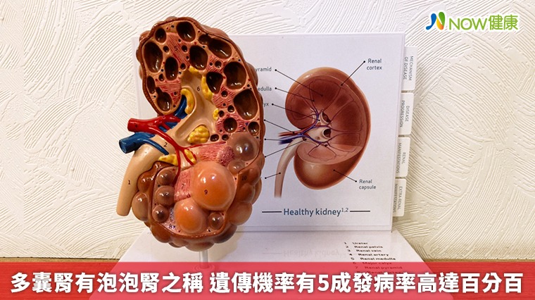 多囊腎有泡泡腎之稱 遺傳機率有5成發病率高達百分百