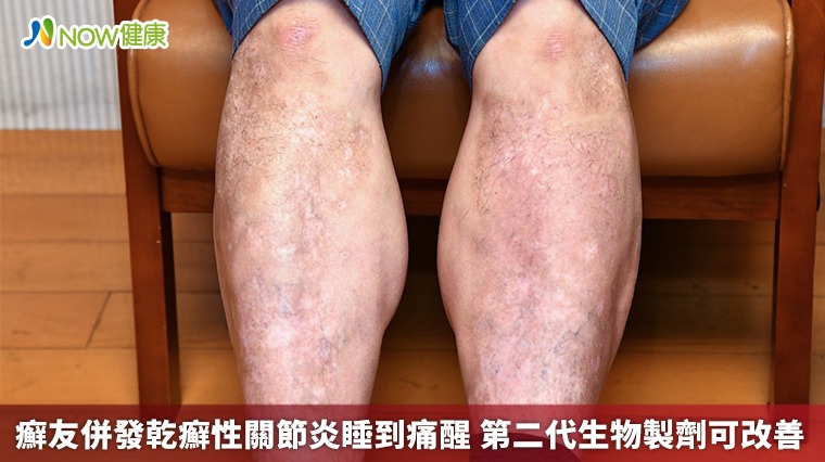 癬友併發乾癬性關節炎睡到痛醒 第二代生物製劑可改善 癬友併發乾癬性關節炎睡到痛醒 第二代生物製劑可改善