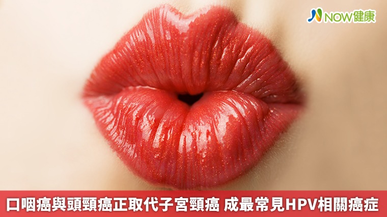 口咽癌與頭頸癌正取代子宮頸癌 成最常見HPV相關癌症 口咽癌與頭頸癌正取代子宮頸癌 成最常見HPV相關癌症