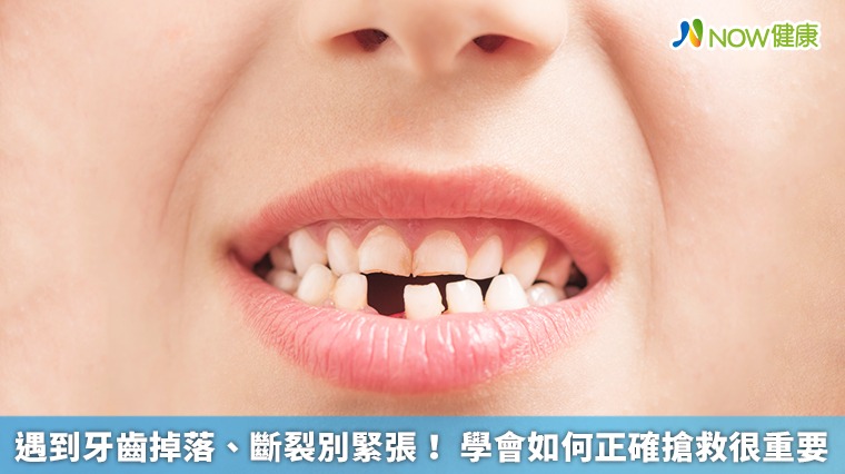 遇到牙齒掉落、斷裂別緊張! 學會如何正確搶救很重要 遇到牙齒掉落、斷裂別緊張! 學會如何正確搶救很重要