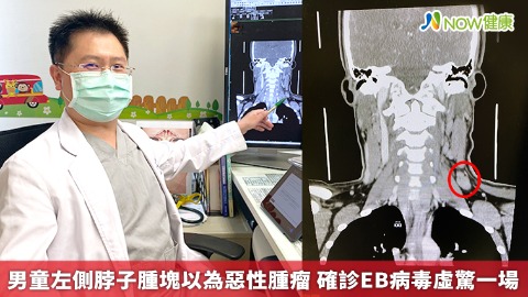 男童左側脖子腫塊以為惡性腫瘤 確診EB病毒虛驚一場