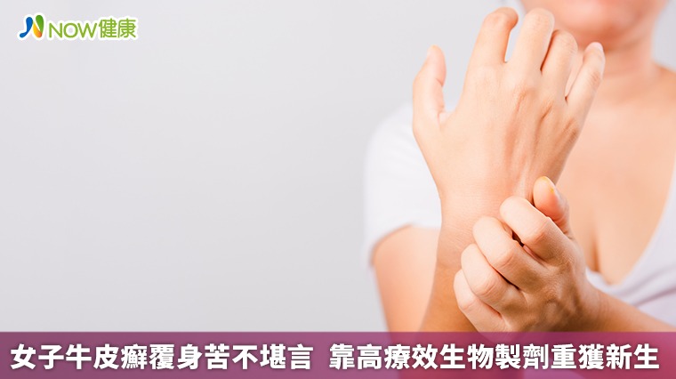 女子牛皮癬覆身苦不堪言 靠高療效生物製劑重獲新生 女子牛皮癬覆身苦不堪言 靠高療效生物製劑重獲新生